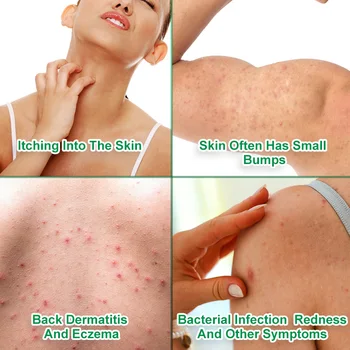Naha Ekseem, Psoriaas Koor Antibakteriaalne Taimne Kreem 20g Dermatiit Eczematoid Ekseem Salvi Ravi Akne Koor Bedsore